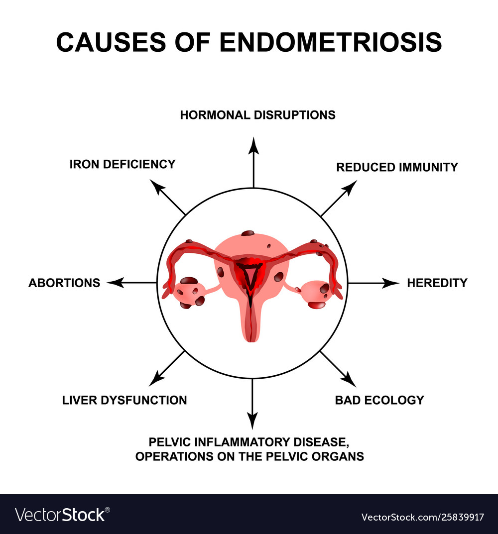 Causes Endometriosis Adenomyosis The Royalty Free Vector