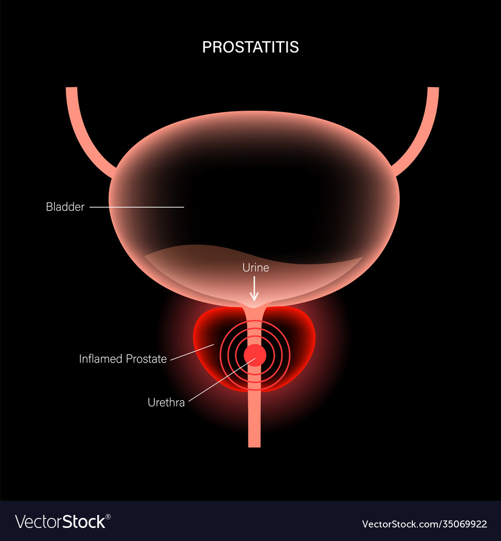 Prostatitis inflammation problem Royalty Free Vector Image