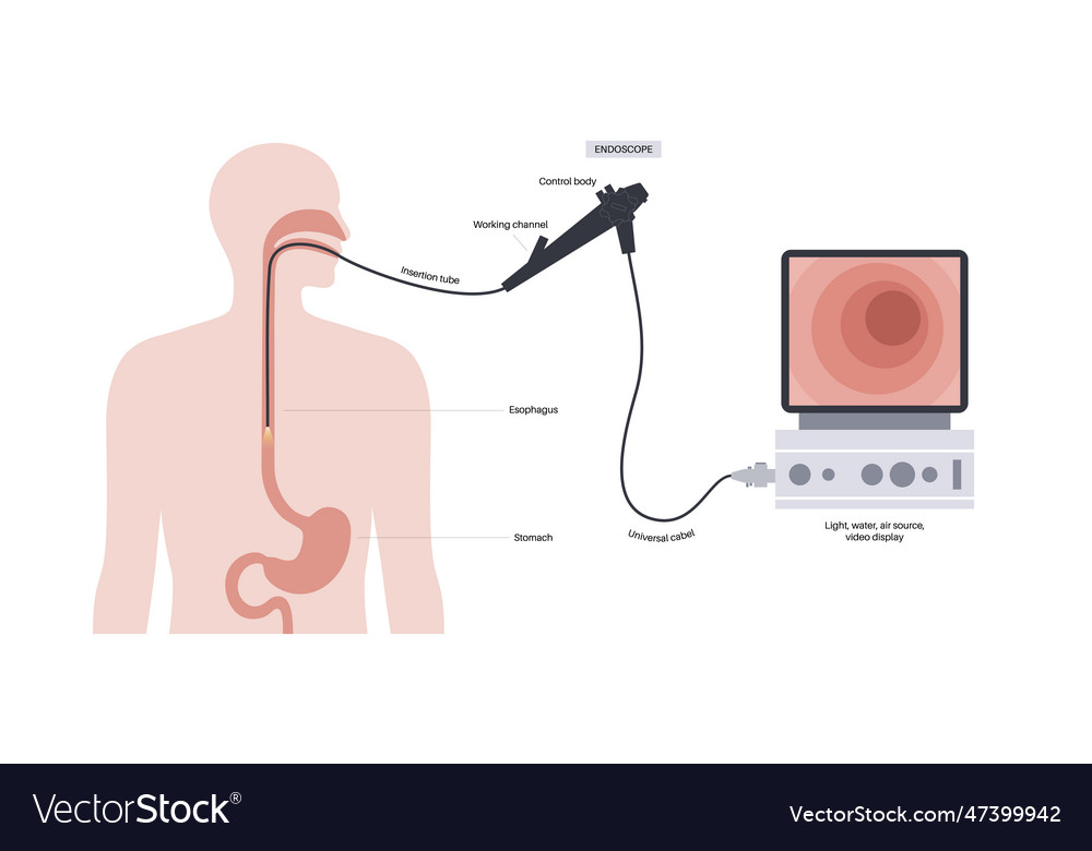 Gastroscopy endoscopy procedure royalty free vector image