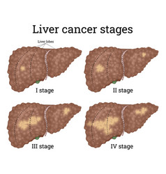 Gradual damage liver Royalty Free Vector Image