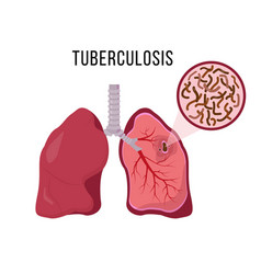 Signs and symptoms pulmonary tuberculosis active Vector Image