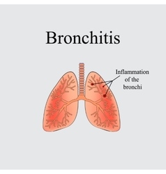 Bronchitis The anatomical structure of the human Vector Image