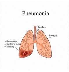 Pneumonia The anatomical structure of the human Vector Image