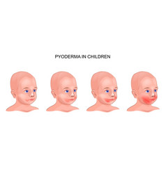 Pyoderma in child Royalty Free Vector Image - VectorStock