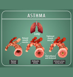 Bronchial asthma diagram with normal airway Vector Image