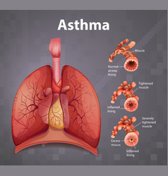 Human anatomy asthma diagram Royalty Free Vector Image