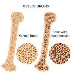 Healthy bone and broken bone with osteoporosis Vector Image