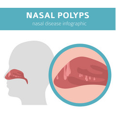 Nasal diseases nasal polyps causes diagnosis and Vector Image