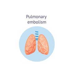 Pulmonary embolism Royalty Free Vector Image - VectorStock