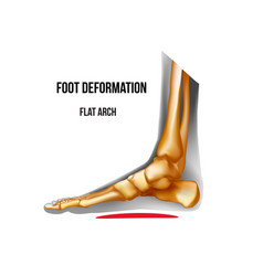 Pronated foot arch deformation bottom view foot Vector Image