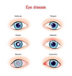 Glaucoma Ophthalmology Vector Images (over 690)