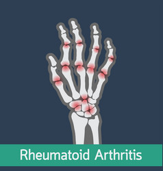 Arthritis Vector Images (over 5,900)