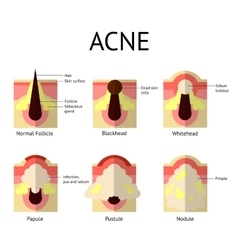 Types of acne pimples Royalty Free Vector Image