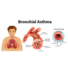 Asthma inflamed bronchial tube Royalty Free Vector Image