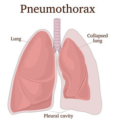 Pneumothorax hemothorax and hemopneumothorax Vector Image