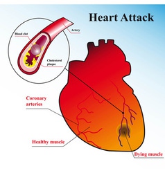 Vessels of the heart bypass surgery Royalty Free Vector