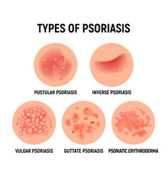 Psoriasis rash skin hand infection Royalty Free Vector Image