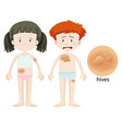 diagram showing hives on boy and girl vector image vector image