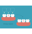how to of invisible braces by tooth concept vector image