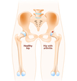 healthy hip and hip with osteoarthritis vector image vector image