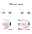 strabismus surgery eye muscle recession vector image
