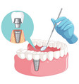 dentist hand with human teeth model vector image