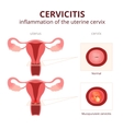 Cervicitis schematic Royalty Free Vector Image