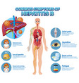 informative poster of common symptoms hepatitis b vector image