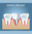 dental implant medical poster design vector image vector image