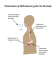 infection with helicobacter pylori infographics vector image